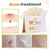 Acne Pimple Patch, 100 Patches Y.F.M Acne Care Pimple Patch Absorbing Cover, Gentle Breathable Cover, Two Universal Sizes Hydrocolloid Bandages (20 Patches 5 Sheet)