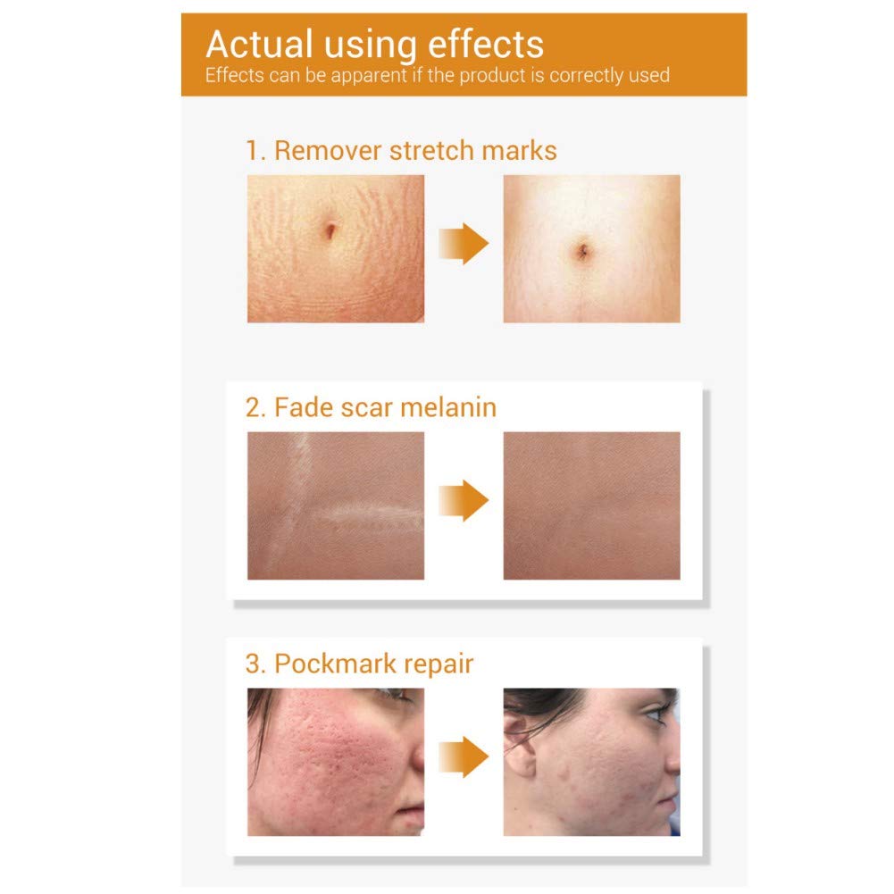 lanbena for stretch marks