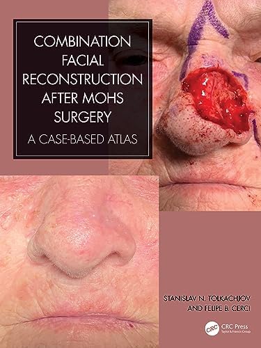 Amazon.com: Local Flaps in Facial Reconstruction E-Book eBook