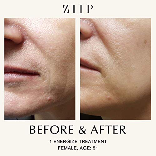 ZIIP Beauty Nanocurrent And Microcurrent At-Home Facial Device for Lifting, Sculpting, and Skin Tightening, Wrinkles, Pigment, and Acne, Patented and Portable, Kit, Conductive Gel, Charger, & Bag 5 ZIIP Beauty Nanocurrent And Microcurrent At-Home Facial Device for Lifting, Sculpting, and Skin Tightening, Wrinkles, Pigment, and Acne, Patented and Portable, Kit, Conductive Gel, Charger, & Bag