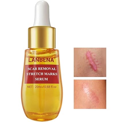 lanbena stretch mark