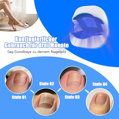 Laser Nail Fungus Fast Action High Efficiency - Cold Laser Therapy Treatment of Multiple Blue Comfortable Toes and Feet Infrared Therapy - Laser Nail Fungus