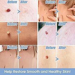 Skin Tag Remover, Skin Tag Removal Kit Tools with