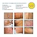 SIlicone Scar Sheets, 4pcs