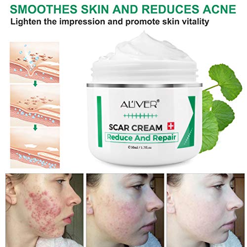 Scar Remover Cream, Reduce and Repair Skin, from CSection, Acne