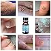 Wart Removal, Penetrates and Removes Common and Plantar Warts, Wart Remover Liquid, Common and Plantar Warts Treatment