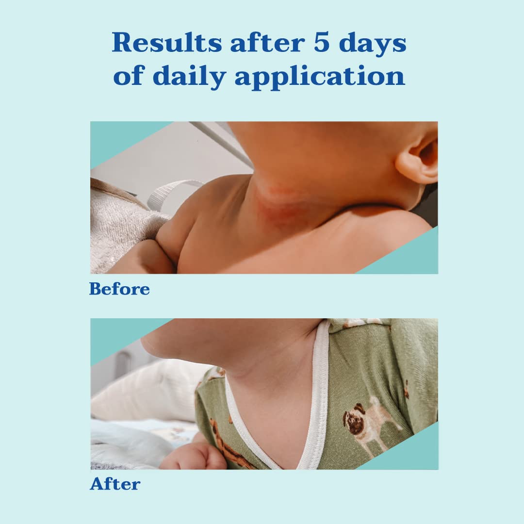 Mustela Eczema Relief Cream Stelatopia Intense - Fragrance-Free Moisturizing Body Lotion with Colloidal Oatmeal - For dry, itchy, irritated skin & flare-ups - Baby, Child & Adult - 5.07 fl. oz.