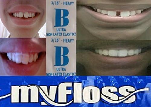 ORTHODONTIC GAP TEETH BANDS 3/16 HEAVY WITH FLOSS by GAPFIX