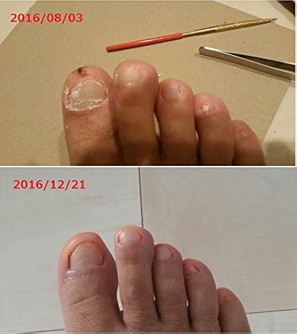 Amazon Co Jp ネイルクリーンキット 熱 研磨 殺菌法 Gwも毎日発送します 爪白癬 足爪の変色 にごり 変形 質感などでお困りの方に ビューティー