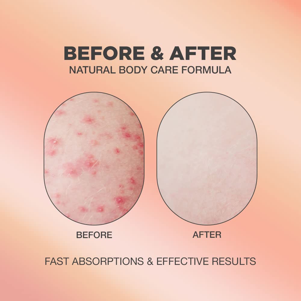 Butt Acne & Ingrown Hair Treatment Serum | AHA & BHA Butt Acne and Ingrown Hair Treatment For Bikini Area | Get rid of Butt Acne, Ingrown Hair, Back Acne, Strawberry Legs, KP and Razor Bump | After Waxing Skin Care | Glycolic and Salicylic Acid Body Serum For Ingrown Hair, Butt and Back Acne Treatment Strawberry Legs | Ingrown Hair Cyst Treatment Formula for All Skin Type | Formulated with Centell