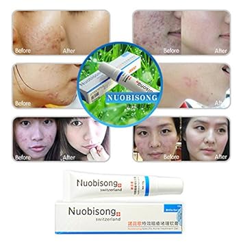 Nuobisong/face skin care treatment the face Pimples scar Stretch Marks removal acne treatment whitening moisturizing cream