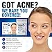 Clear24 Ultra Thin Pimple and Blemish Cover Patch - Ideal for Day Use, 144 Patches