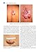 Cutaneous Soft Tissue Tumors