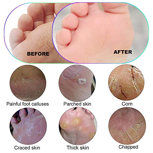 Colossal Foot Rasp Foot File - Callus Remover Ejiubas Foot Care Metal Pedicure Tool Hard Skin Remover for Both Wet And Dry Feet Surgical Grade Stainless Steel Pedicure File