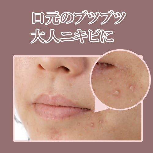 Amazon 口周りの白いポツポツに シロトリンｂ イザヴェル ビューティー 通販