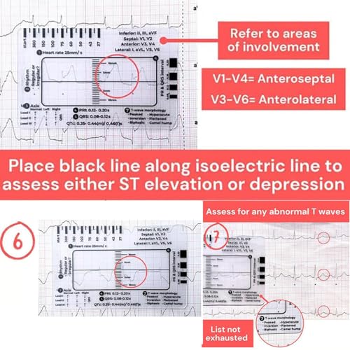 Transparent Ecg Ruler/Card, Transparent Ecg Ruler Card, Ecg/Ekgs Made Easy By Following A 7 Step Plan, Ekg Calipers Measuring Tool, Ideal For Students, Paramedics, Emt'S, Nurses 1PC (A)