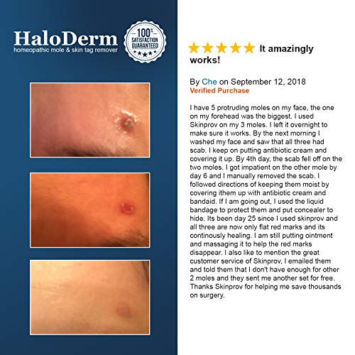 HaloDerm Skin Tag Remover & Skin Growth Remover Homeopathic Fast