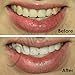 StyleSmile Envy Teeth Whitening Kit: 2X 3ml Syringes, 2X 3ml Remin Gel Syringes, 5-LED Fast-Acting Light, Custom Trays, Maintenance Pen