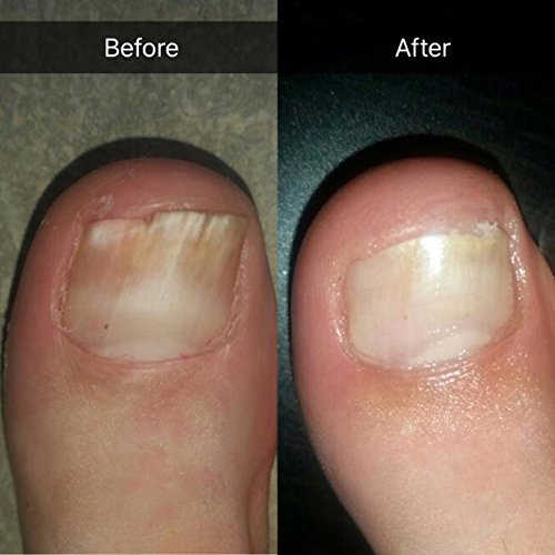 Probelle "Extra Strength" Natural Fungal Nail Gel Topical Treatment