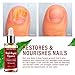Nail Fungus Repair, Maximum Strength Fungal Toenail Solution, Nail Repair, Restores Healthy Appearance of Discolored & Damaged Nail