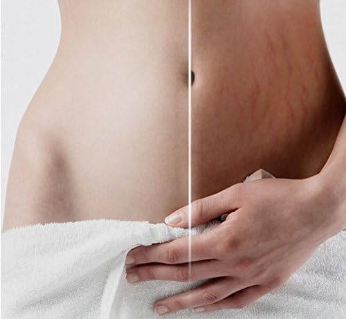 Cream for Stretch Marks and Scar Removal Powerful to Stretch Marks Maternity Skin Body Repair Cream Remove Scar Care Postpartum