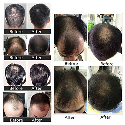 2PCS Ginger Germinal Oil Hair Growth Serum + Bonus Hair Comb | Ginger Hair Growth Serum | Ginger Essential Oil Hair Loss Treatment | Hair Regrowth Serum For Women & Men 30ML