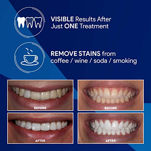Dental Duty Teeth Whitening Kit - 2 Whitening Pens, 35% Carbamide Peroxide Gel,14 Strips & LED Light for Whiter Teeth- Effectively Whitens, Whiter Tooth, Best Stain Remover for Bright White HiSmile