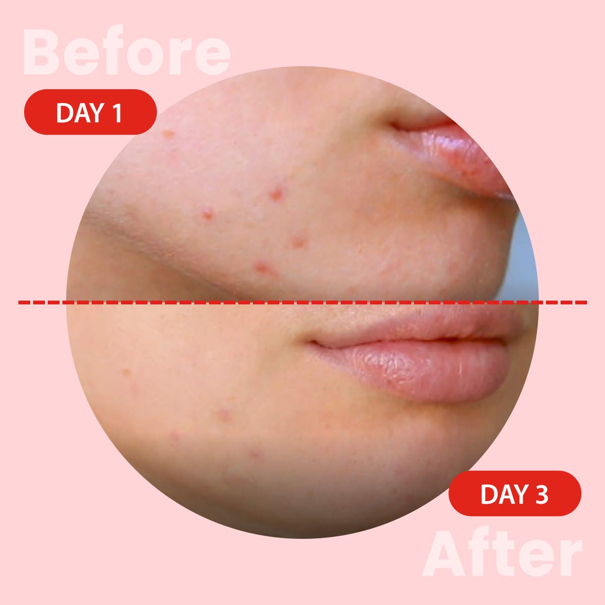 glam up pimple patch