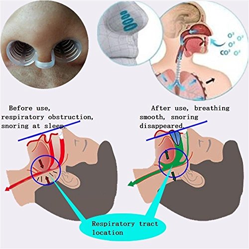 Wild Tribe Set of 8 Premium Anti Snore Aid To Prevent Snoring, Deviated Septum.Smarter Solution Against Snoring (Advanced Design Save Your Lungs)