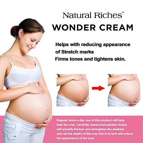 3 Stretch+Marks+Removal+Natural+Riches