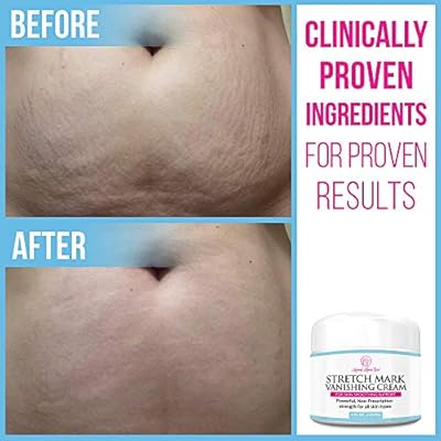 mommy knows best stretch mark vanishing cream