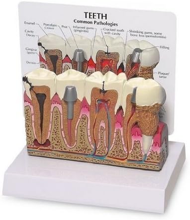 YOHOSO Diseased Teeth and Gums Model-Patient Education Dental Model
