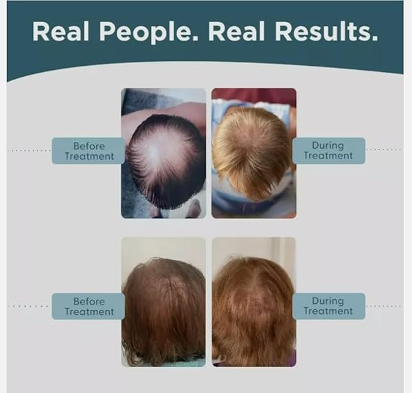MEMBER’S MARK HAIR LOSS REGROWTH TREATMENT FOR MEN, 2OZ, 6-MONTHS SUPPLY, PACK OF 6, BLACK