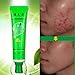 ULAKY Removal Blemish Facial Effective Acne Treatments Gel Care Face Skin Cream Pure & Clear Acne Treatment Gel