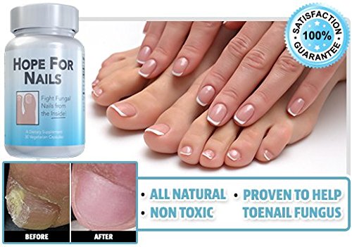 Hope For Nails Supplement for Nail Fungus