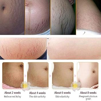rtopr stretch mark cream