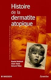 Histoire de la dermatite atopique