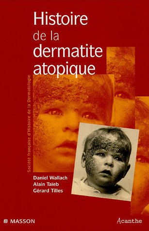 Histoire de la dermatite atopique