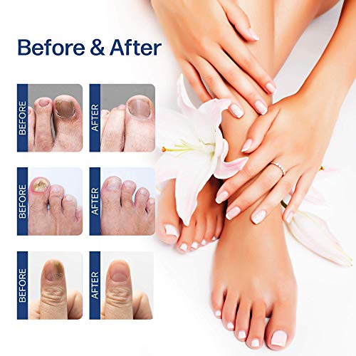 Nail Fungus Treatment Perfect for Both Toenails and Fingernails, for