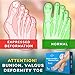 VILLINI Bunion Corrector Splint Big Toe - Gel Pads - Orthopedic Corrector Brace Pads & Metatarsal Pads - Elastic ‎Bunion Corrector for Women and Men - Non Surgical Hallux Valgus Correction Relief