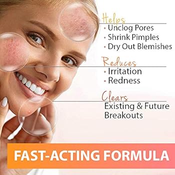 the best solution for pimples