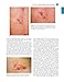 Cutaneous Soft Tissue Tumors