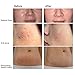 540 Micro Needles Titanium Microneedle Derma Roller Needle Skin Care Face Roller, 0.25 mm. FDA approved