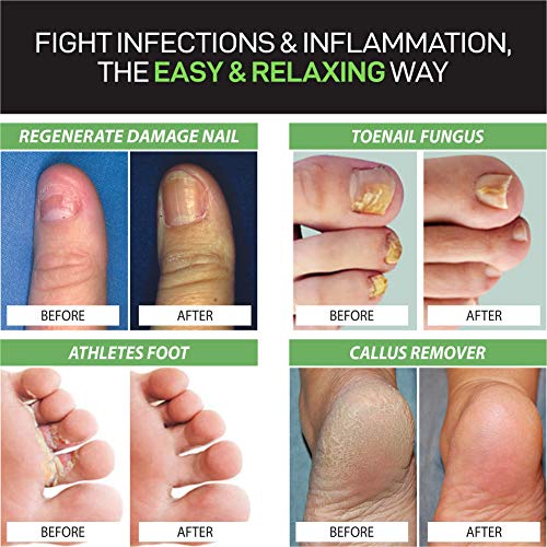 Amazon Com 2 In 1 Foot Care Treatment Kit Includes Tea Tree Oil Foot Soak Nail Fungus Pen To Get Rid Of Toenail Fungus Athletes Foot Foot Odor Removes