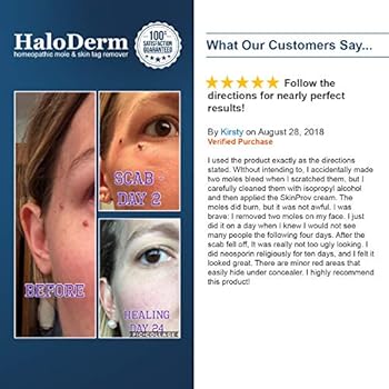 haloderm skin tag remover