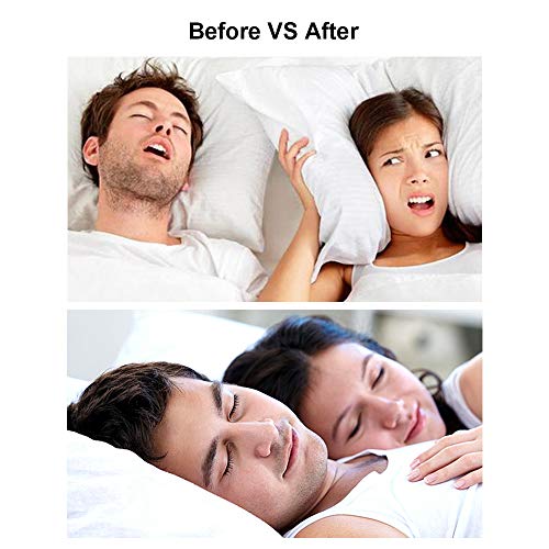WoodyKnows Anti-Snoring Advanced Nasal Dilators Nose Vents to Ease Snoring and Breathing - Good Alternatives to Nasal Strips Chin Strap Jaw Strap Supporter (Multi-size Pack)