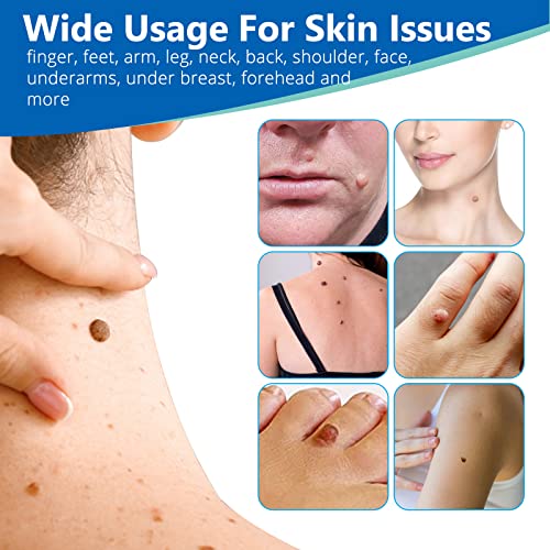 2 Size Automatic Removal Pen Set, Effective, Painless, Easy And Safe For Small To Large Size Warts And Moles (1-9 MM)