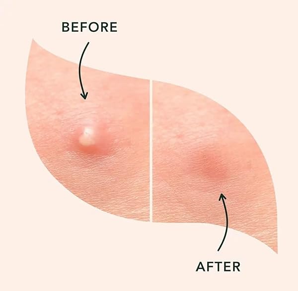 ACNE PIMPLE HEALING PATCH – FAST RESULTS- CLEAR IMPURITIES – SKIN PERFECTING