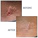 Xeragel 100% Silicone Scar Treatment Ointment 10g – Scar Gel for Smoother, Flatter Scars from Surgery, Burns, Acne & More - For Old & New Scars on Face, Neck & Hands - Hypoallergenic & Fragrance-free