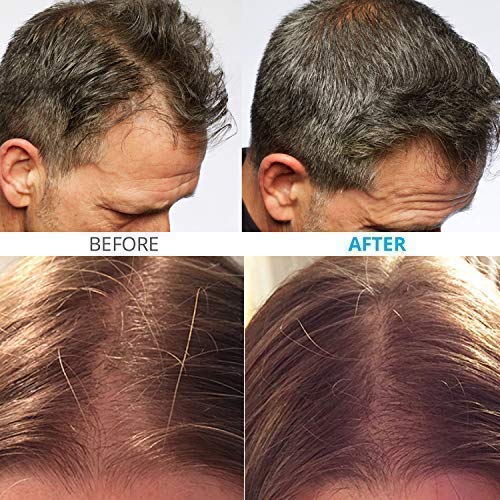 Theradome PRO LH80 Medical Grade Laser Hair Growth Helmet FDA